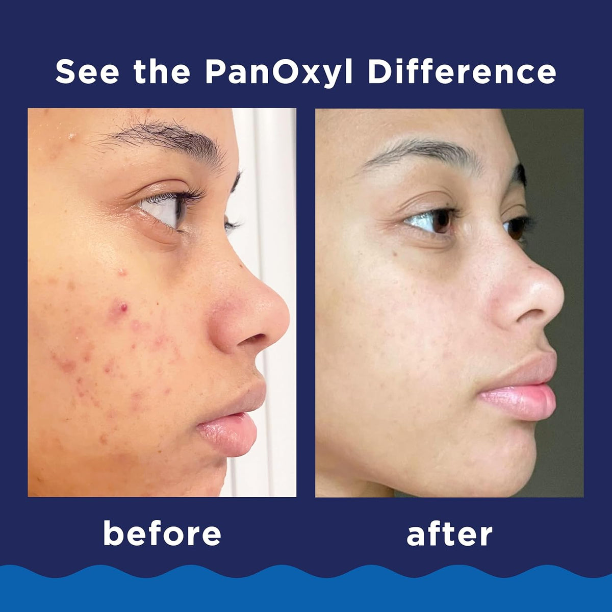 Acne Foaming Wash Benzoyl Peroxide 10% Maximum Strength Antimicrobial, 5.5 Ounce (Pack of 1)